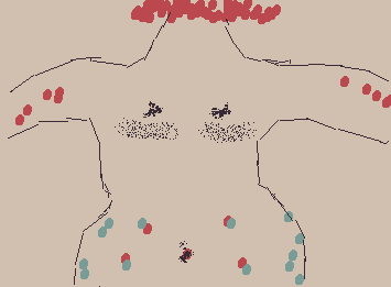 a gif of a crudely drawn torso, covered in dots. The torso isn’t moving, but the linework is, giving it a slightly flickering appearance. There’s a group of small, black dots drawn across and underneath the nipples, where top surgery scars would be.

There are also larger, red and blue dots covering the rest of the body; the blue dots are covering the hips, with a few red dots here and there. The rest of the red dots are around the arms and across the neck.